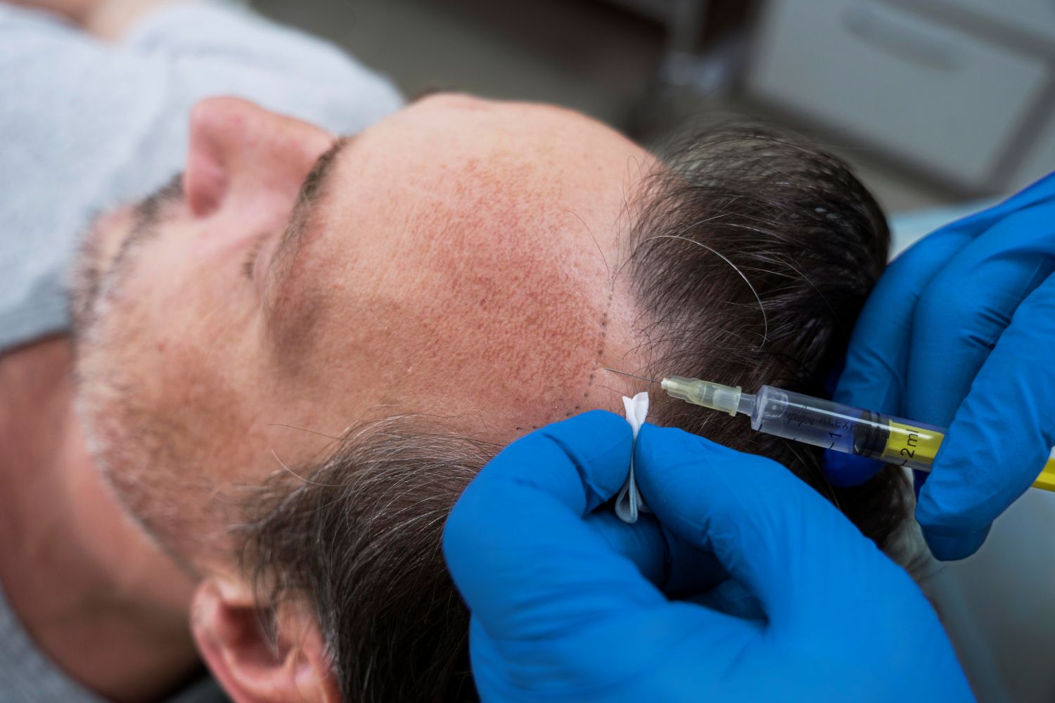 man getting a hair transplant